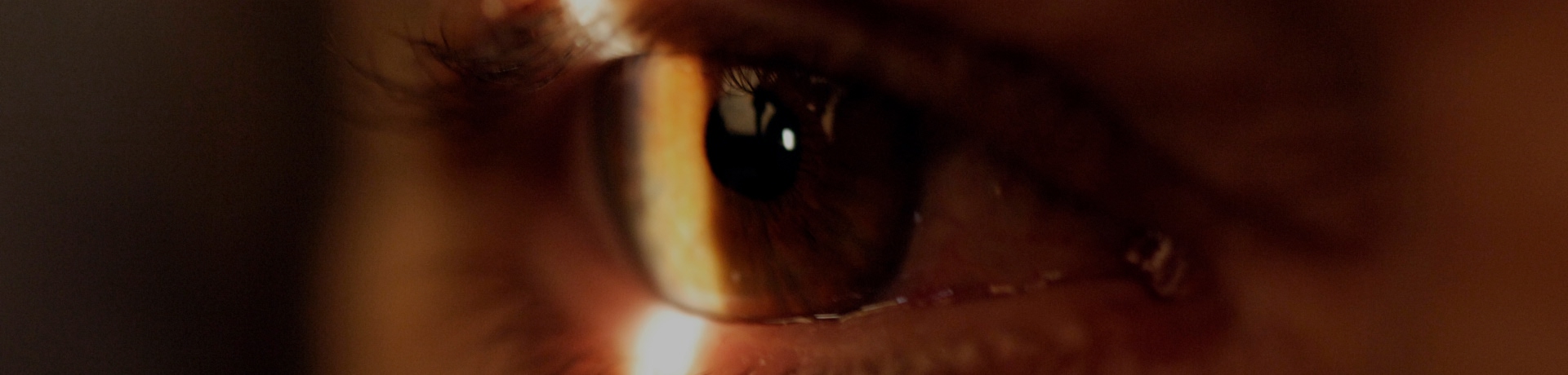 GLAUCOMA
